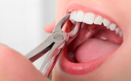 Mơ thấy nhổ răng đánh con gì? Ý nghĩa giấc mơ thấy nhổ răng